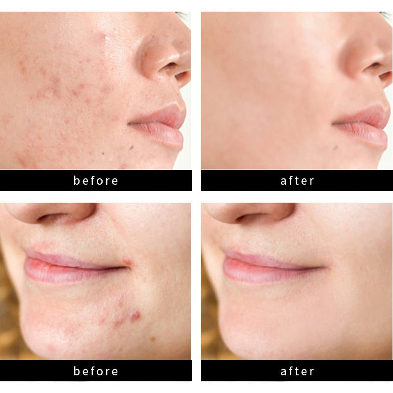 Acne Scar Patch